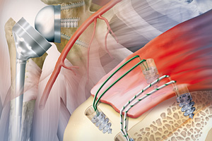 Der Tätigkeitsschwerpunkt unserer chirurgischen Eingriffe ist die Schulter. Wir schaffen Abhilfe, wenn Sie beispielsweise an einer Kalkschulter leiden, oder Verletzungen im Bereich der Rotatorenmanschette haben. Auf dem Bild sehen Sie eine arthroskopische Rotatorenmanschettennaht. Der Tätigkeitsschwerpunkt unserer chirurgischen Eingriffe ist die Schulter. Wir schaffen Abhilfe, wenn Sie beispielsweise an einer Kalkschulter leiden, oder Verletzungen im Bereich der Rotatorenmanschette haben. Auf dem Bild sehen Sie eine arthroskopische Rotatorenmanschettennaht.